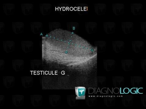 Hydrocele, Scrotum, US