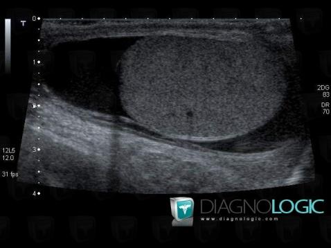 Hydrocele, Scrotum, US