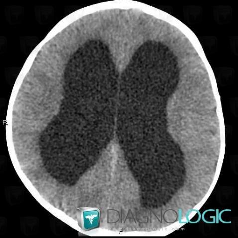 Hydrocephalus, Ventricles / Periventricular region, CT