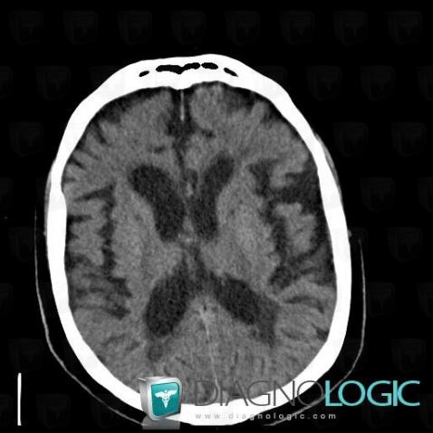 Hydrocephalus, Ventricles / Periventricular region, CT