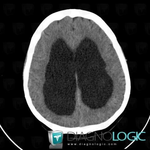 Hydrocephalus, Ventricles / Periventricular region, CT