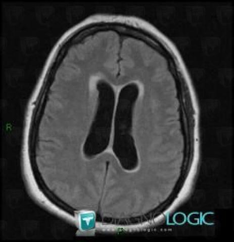 Hydrocephalus, Ventricles / Periventricular region, MRI