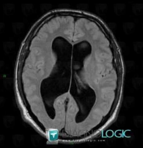 Hydrocephalus, Ventricles / Periventricular region, MRI