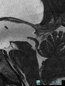 Hydrocephalus, Ventricles / Periventricular region, MRI