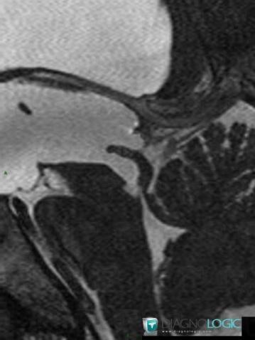 Hydrocephalus, Ventricles / Periventricular region, MRI