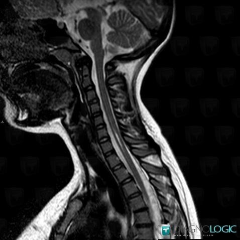 Hydromyelia, Spinal canal / Cord, MRI