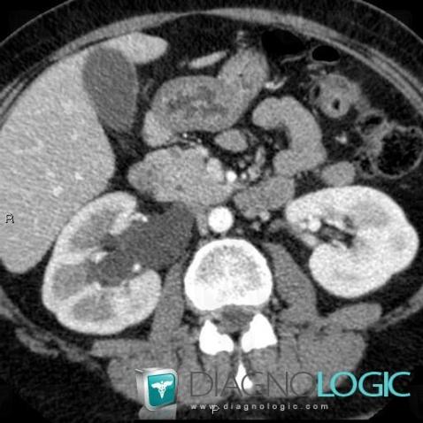 Hydronephrosis, Kidney, CT