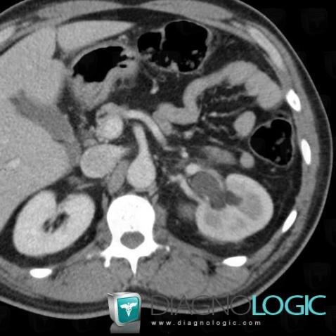 Hydronephrosis, Kidney, CT