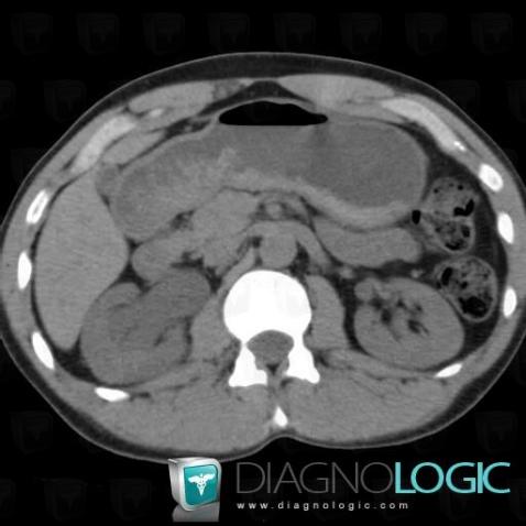 Hydronephrosis, Kidney, CT