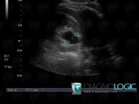 Hydronephrosis, Kidney, US