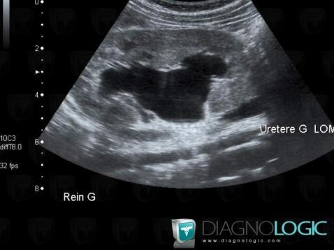 Hydronephrosis, Kidney, US