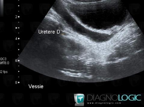 Hydronephrosis, Ureter, US