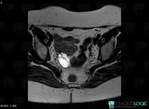 Hydrosalpinx, Adnexa / Ovary fallopian tube, Pelvis / Perineum, MRI