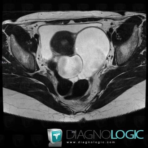 Hydrosalpinx, Adnexa / Ovary fallopian tube, Pelvis / Perineum, MRI