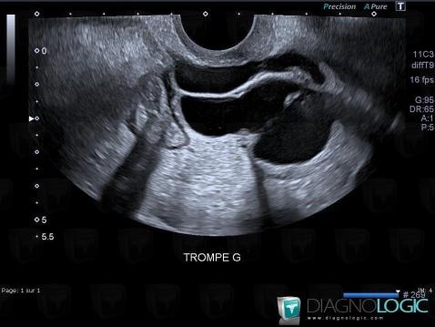 Radiology case : Hydrosalpinx (US) - Diagnologic