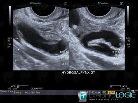 Hydrosalpinx, Adnexa / Ovary fallopian tube, US