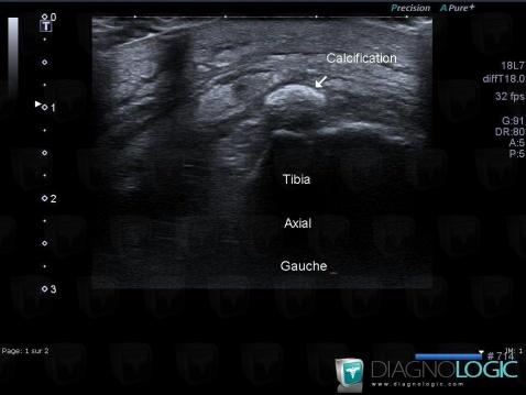 Hydroxyapatite deposition disease, Other soft tissues/nerves - Ankle, US