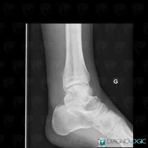 Hydroxyapatite deposition disease, Other soft tissues/nerves - Ankle, X rays