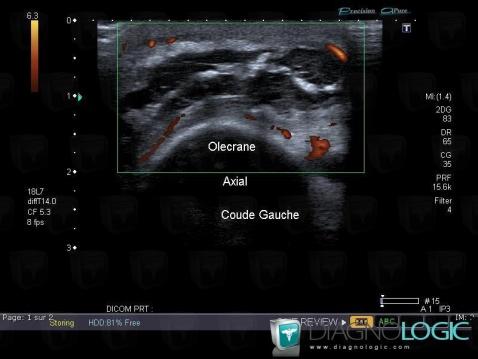 Hygroma, Autres parties molles/nerfs - Coude, Echographie