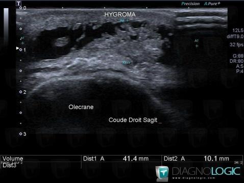 Hygroma, Other soft tissues/nerves - Elbow, US