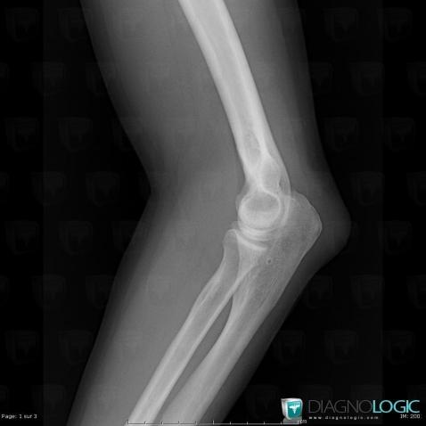 Hygroma, Other soft tissues/nerves - Elbow, X rays