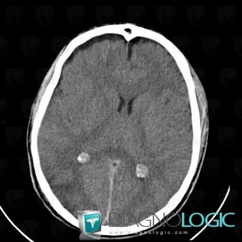 Hygrome sous dural, Espaces peri cérébraux supratentoriels, Scanner