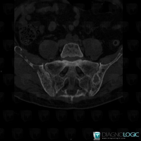 Hyperparathyroïdie, Articulation sacro iliaque, Scanner