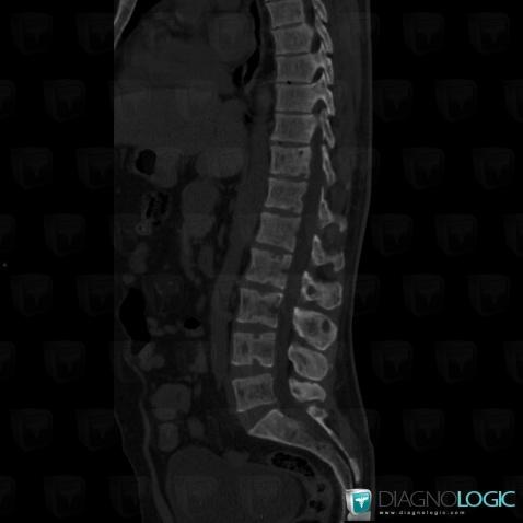 Hyperparathyroïdie, Corps vertébral / Disque, Scanner