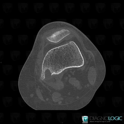 Hyperparathyroïdie, Fémur -inférieur, Scanner