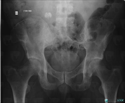 Hyperparathyroïdie, Os iliaque, Radio