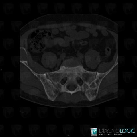 Hyperparathyroïdie, Os iliaque, Scanner