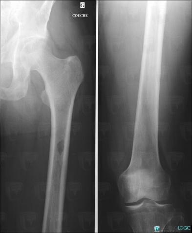 Hyperparathyroidism, Femur - Proximal part, Femur - Mid part, X rays