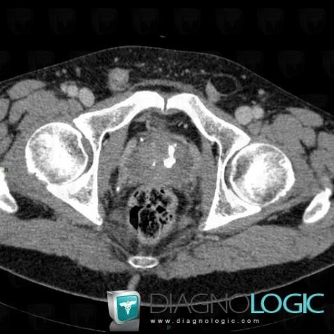 Hypertrophie bénigne de-prostate, Prostate, Scanner