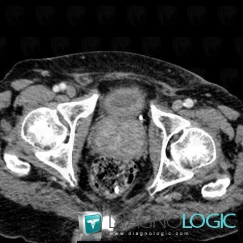 Hypertrophie bénigne de-prostate, Prostate, Scanner