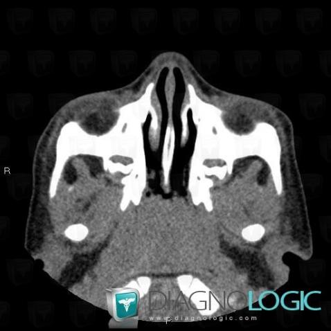 Hypertrophie-végétations adénoïdes, Fosses nasales / Nasopharynx, Scanner