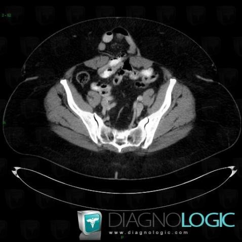 Hypogastric hernia, Abdominal wall, CT