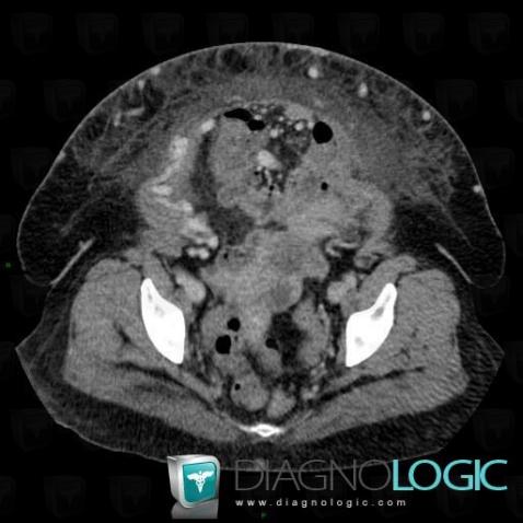 Hypogastric hernia, Abdominal wall, CT