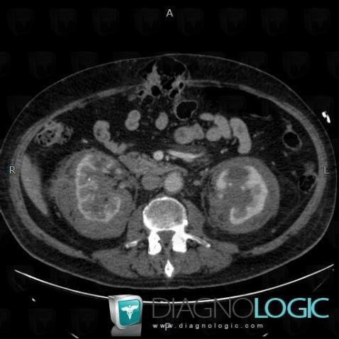 Hypogastric hernia, Abdominal wall, CT