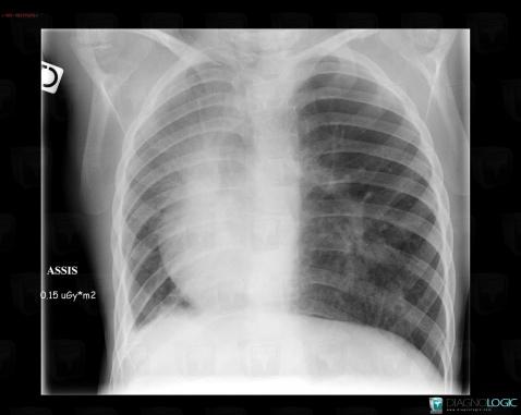 Hypoplasie pulmonaire, Parenchyme pulmonaire, Radio