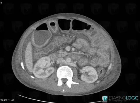 Hypoproteinemia, Colon, CT