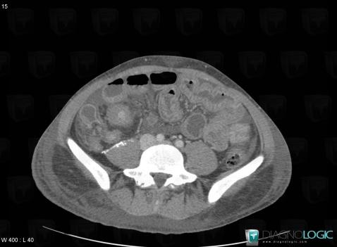 Hypoproteinemia, Small bowel, CT