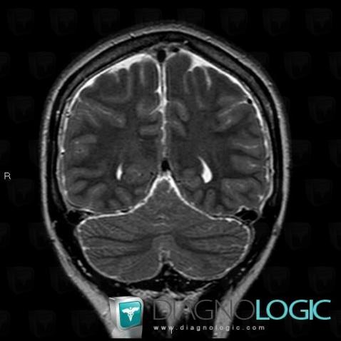 Hypotension intracrânienne , Espaces peri cérébraux infratentoriels, IRM