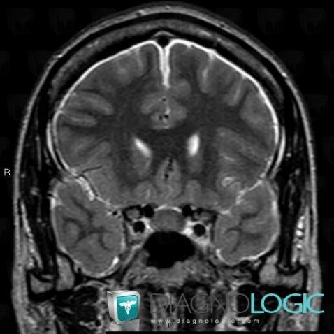 Hypotension intracrânienne , Espaces peri cérébraux supratentoriels, IRM