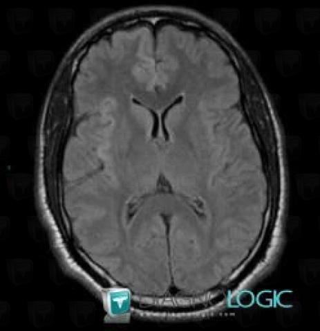 Hypoxie corticale, Région cortico sous corticale, IRM