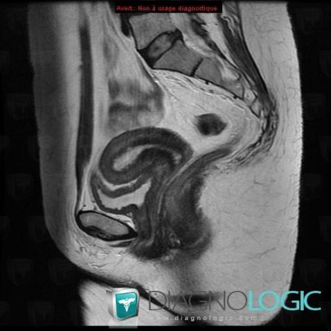 Iatrogenic, Uterus, MRI