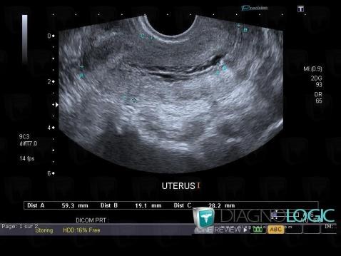 Iatrogenic, Uterus, US