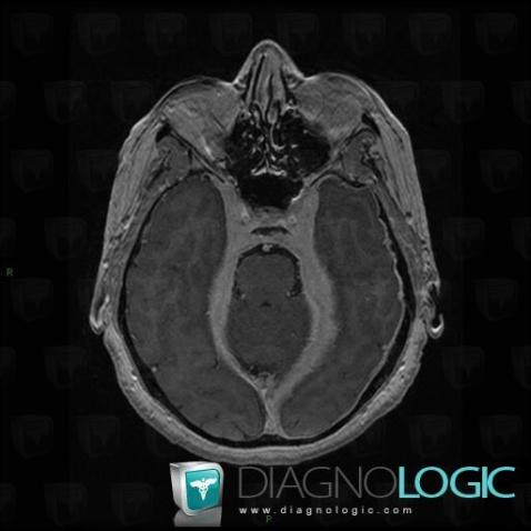 Idiopathic hypertrophic pachymeningitis, Supratentorial peri cerebral spaces, MRI