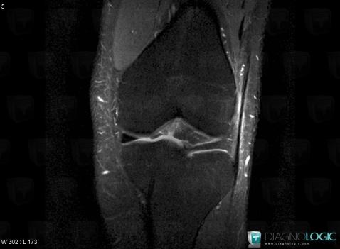 Iliotibial band friction syndrome, Ileo tibial tract, MRI