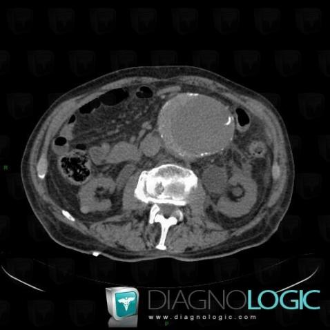 Impending aortic rupture, Abdominal aorta, CT