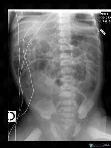 Imperforate anus, Rectum, X rays